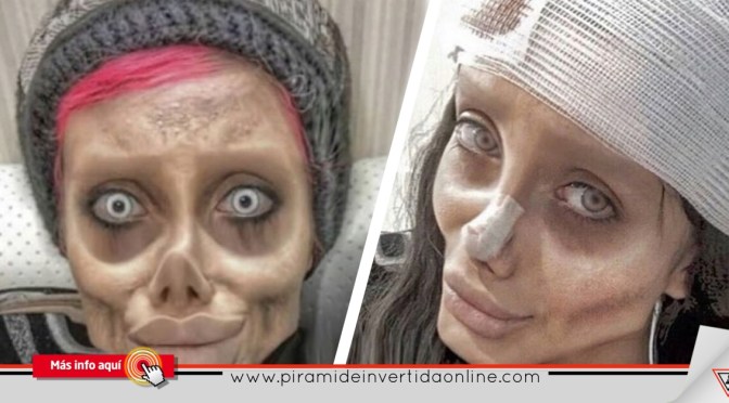 Quería parecerse a Angelina Jolie y se operó 50 veces…Ahora parece un Zombie